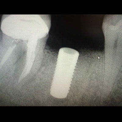 3D X-Ray Dental Implant Imaging