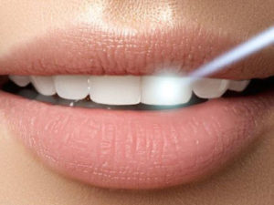 laser dentistry smile