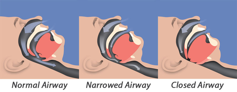 Sleep Apnea Airway Illustration Sleep Apnea Airway Illustration