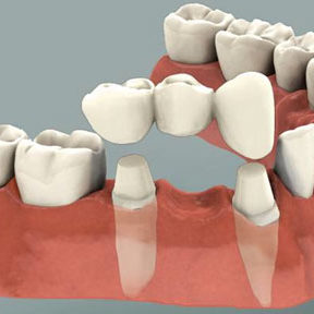 Dental Bridge Illustration