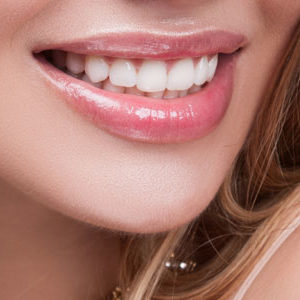 Woman smiling with veneers